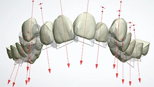 Gradual Tooth Movement