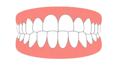 Underbite